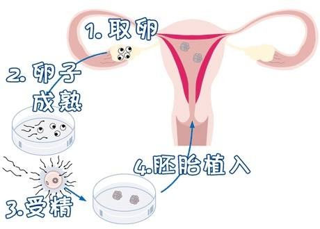無精症
